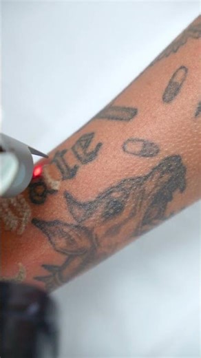 Laser Tattoo Removal | Before & After Results #Shorts