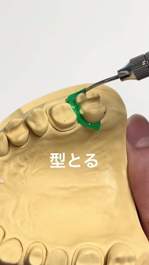 超ざっくり詰め物型取りの流れ🦷 #デンタルオフィス北野 #明石駅歯医者 #歯科衛生士 #明石駅 #歯医者さん #歯科医師 #歯科助手