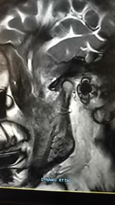 #tmj #MRI #anatomy #arteries #lesions | CT Scan and MRI study