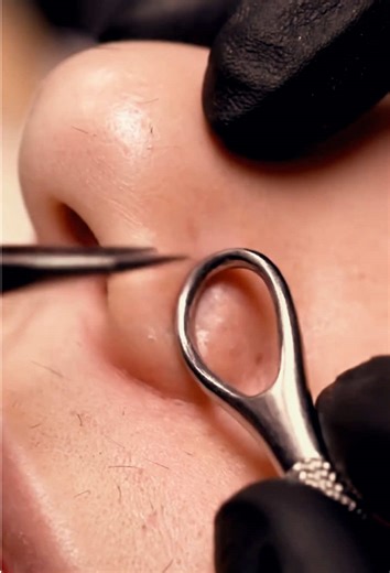 Nose Comedone Extraction | Extreme Macro 4K #macroasmr #satisfying #macroextraction