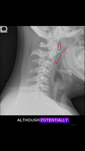 Cervical Spine X-ray Interpretation #radiology #anatomy