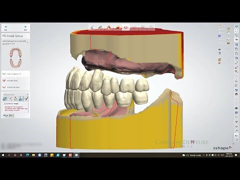 Class 3 Occlusion Digital Denture Design