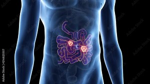 medically accurate 3d animation of bowel cancer
