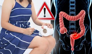 Bowel cancer warning: Does your poo sink or float? Hidden signs