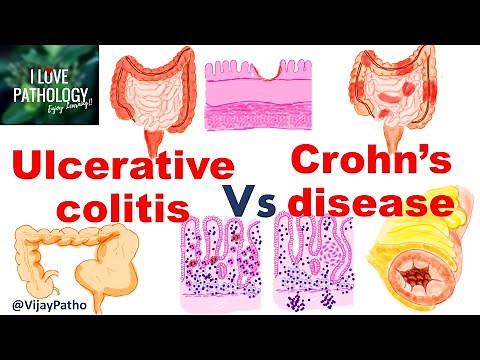 Ulcerative colitis Vs Crohn's disease #inflammatoryboweldisease