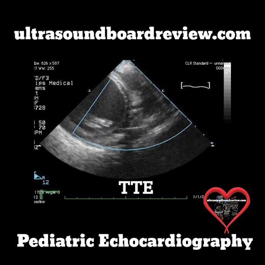 ALCAPA Echocardiography