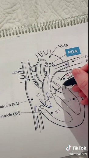 Reply to @becomingaqueen20 cardiac defects made easy 😌 #congenitalheartdisease #chf #chd #chdawareness