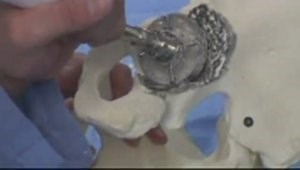 Acetabular Revision of Type 3B Defects with Cages and Metal Augments