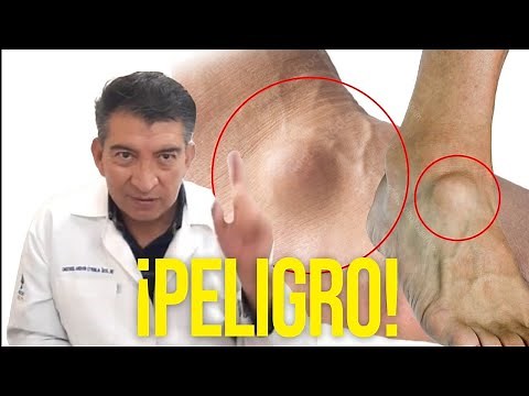 Ganglion or Synovial Cyst. Brief Explanation