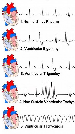 ECG comparison (NSR, ventricular bigeminy, ventricular trigeminy, NSVT & VT) #ecg #cardiology