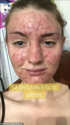 Still Getting Pimples? Acne by Location Explained 😳 | Dermatologist Tips