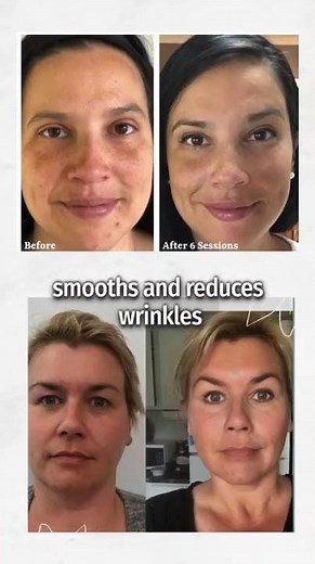 Experience the Non-Invasive Facelift: Microcurrent Facial Treatment