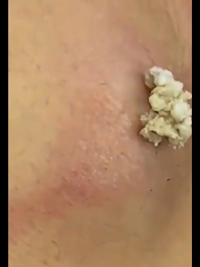 The Ultimate Guide to Pimple Popping Techniques