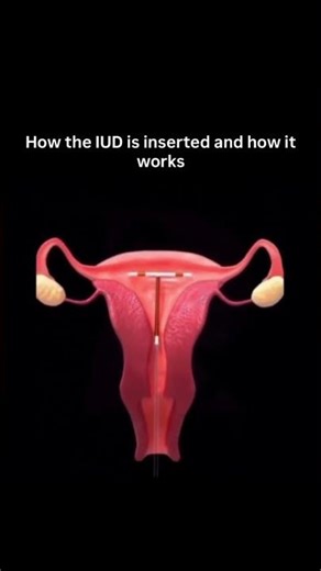 IUD insert #analysis #medicare #facts #anatomy
