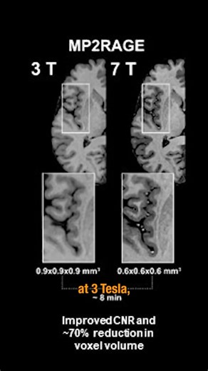 Sunnybrook Hospital on Instagram: "With the power of 7T MRI, we’re inventing the future of health care. Toronto’s first 7T MRI, housed at Sunnybrook, is part of the Toronto Neuro-Immunology/Imaging Consortium and funded in partnership with the following TAHSN partners: @Baycrest, @sickkidstoronto, @uhntoronto, @camhnews, @unityhealthto, and the @uoftmedicine. We’re grateful for support from the Canada Foundation for Innovation and @ongov for making this possible."