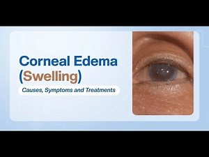 Corneal Edema (Accumulation of Fluid Behind Eye Cornea) ; Definition, Causes, Symptoms, Diagnosis