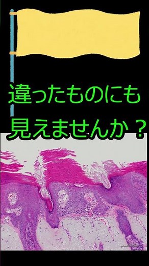 何かに似ている病理組織像⑤ 日光角化症