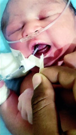 NG Tube Removal in a Newborn Baby | Gentle NICU Care 😘 #NewbornBaby #NGTube #NGTubeRemoval