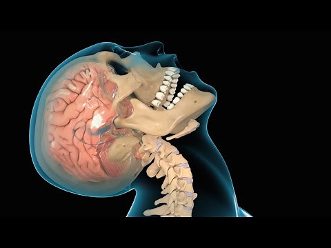 Concussion / Traumatic Brain Injury (TBI) Tua Football Injury