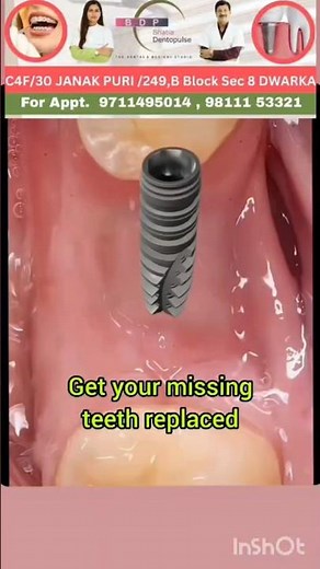 Best way to replace missing tooth? Find out! #implants #missingteeth