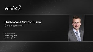 Hindfoot and Midfoot Fusion
