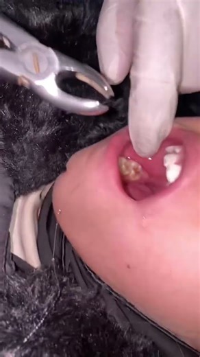 Tooth extraction | molar tooth | #dentist