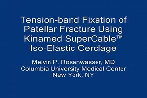 Fixation of Patellar Fracture using Kinamed SuperCable - Melvin P. Rosenwasser, MD