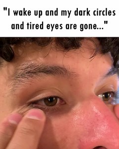 14K views · 201 reactions | Acne scars, dark eye bags, wrinkles, the...