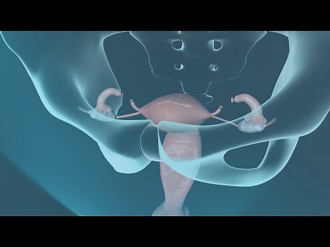 Tubal Ligation Surgery