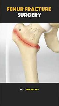 How Femur Fracture Surgery Is Performed | Step-by-Step Orthopedic Procedure #orthopedicsurgery