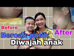 CAUSES & HOW TO REMOVE WHITE SPOTS ON CHILDREN'S FACE