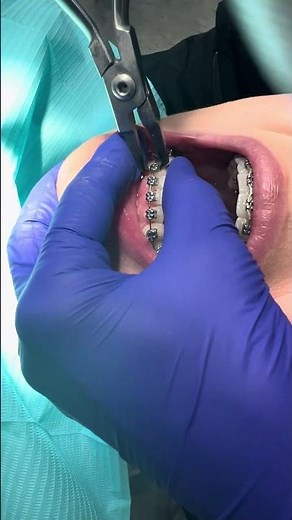 What Happens When Braces Come Off? | Braces Removal Explained