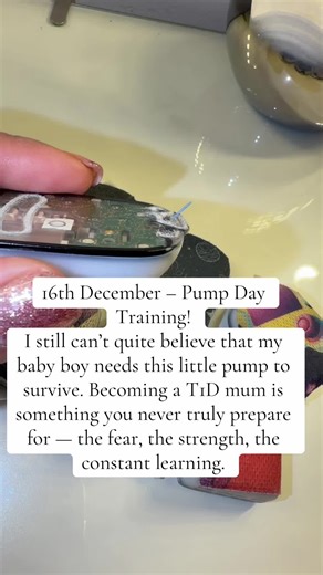 Embracing Freedom with Omnipod for Type 1 Diabetes