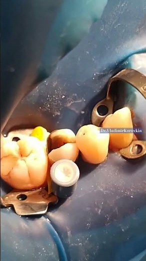 Insert matrix 45 tooth.Super mat Kerr Hawe.