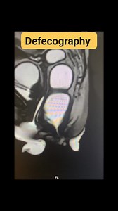 #MRI #Defecography #CT #CTScan | CT Scan and MRI study
