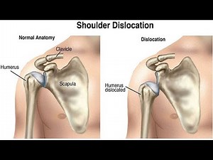 Watch how to sign 'dislocate' in American Sign Language.