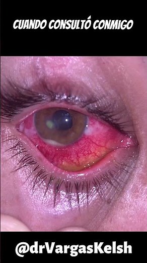 A BIG MISTAKE with Contact Lenses