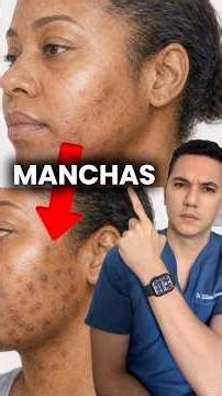 Dark and light spots after skin diseases. #dermatologowilliamguerrero #dermatology