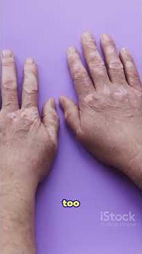 Episode 4 Types of Vitiligo“Segmental, non-segmental & more – know the types.”