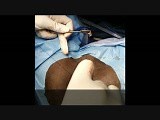 Anal Sphincter Reconstruction - Sphincteroplasty • Video • MEDtube.net