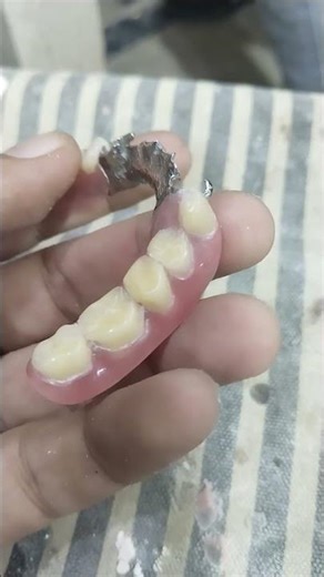 Cost Removable Partial Denture 😁😁😁#rpddentalprocedure