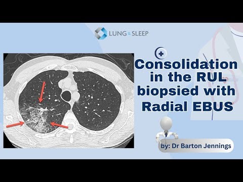 Consolidation in the RUL biopsied with radial EBUS