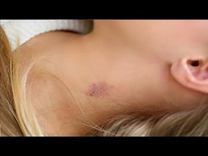 easiest way to give a hickey in 3 minutes