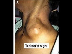 Anatomy and applied anatomy of Troiser's sign Enlargement of supraclavicular lymph nodes