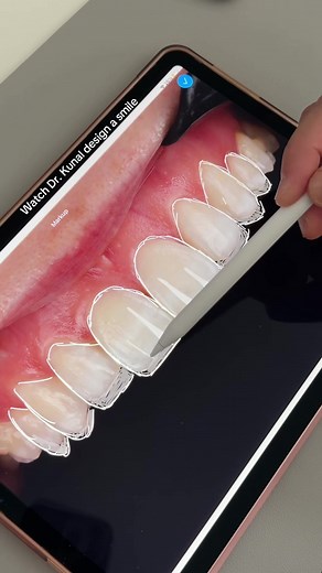 Composite Bonding Smile Design by Dr. Kunal