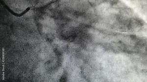Catheterization. Cardiac ventriculography is a medical imaging test used to determine a patient cardiac function in the right or left ventricle Stock Video