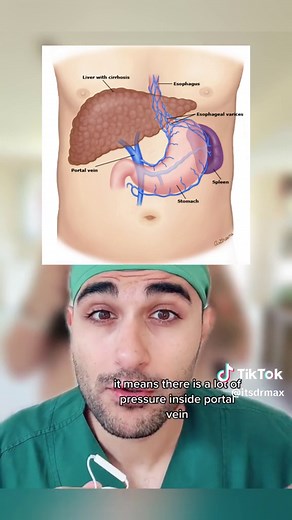Ascites: Causes, Symptoms, and Treatment Explained