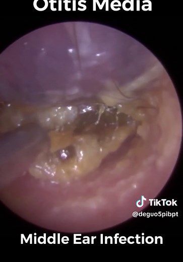 Middle Ear Infection Otitis Media | infected