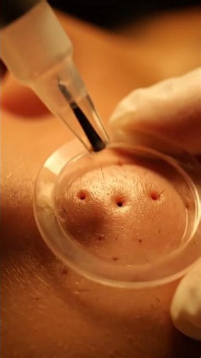 Incredible Suction Results — Filaments Pulled Out Clearly! 😱✨#SkinDetail #CloseUpASMR #FacialASMR