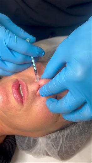 Practical BoNT-A micro-injection on the frontalis area